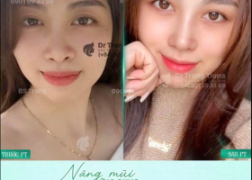 Nâng mũi siêu vi phẫu: 7 lầm tưởng và sự thật thú vị