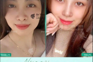 Nâng mũi siêu vi phẫu: 7 lầm tưởng và sự thật thú vị