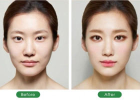 Cấy mỡ mặt làm đầy má hõm: Bí quyết cho gương mặt đầy đặn