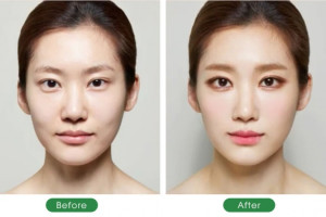 Cấy mỡ mặt làm đầy má hõm: Bí quyết cho gương mặt đầy đặn