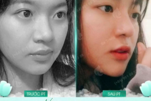 Nâng mũi siêu vi phẫu cho người có da mũi mỏng: Cần lưu ý gì?