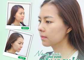 Nâng mũi siêu vi phẫu Surgiform: Kiến tạo dáng mũi tự nhiên hoàn hảo 