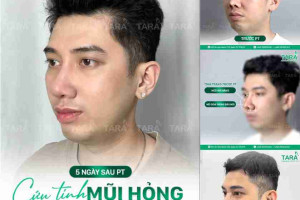 Nâng mũi siêu vi phẫu trung bì mỡ: Giải pháp cho mũi nhiễm trùng