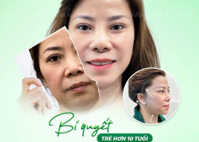 Nên phẫu thuật căng da mặt hay căng da bằng chỉ?