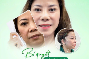 Nên phẫu thuật căng da mặt hay căng da bằng chỉ?