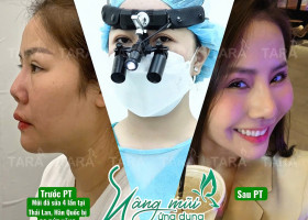 Sửa mũi hỏng siêu vi phẫu: Giải pháp tái tạo mũi tự nhiên & an toàn