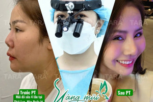 Sửa mũi hỏng siêu vi phẫu: Giải pháp tái tạo mũi tự nhiên & an toàn