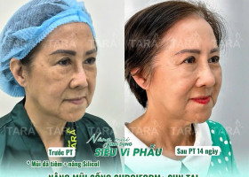 Lệch vẹo, co rút, nhiễm trùng: Dấu hiệu nguy hiểm sau nâng mũi
