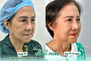 Lệch vẹo, co rút, nhiễm trùng: Dấu hiệu nguy hiểm sau nâng mũi