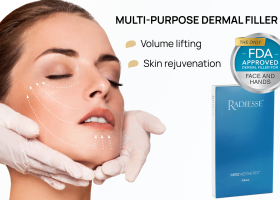 Tiêm Radiesse cằm: Khắc phục khuyết điểm cằm hoàn hảo