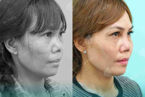 Trung bì mỡ: “vật liệu vàng”  trong sửa mũi hỏng  