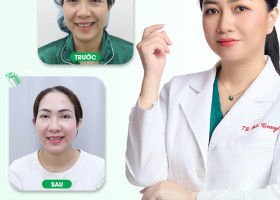 5 kỹ thuật căng da mặt phổ biến hiện nay: Đâu là giải pháp tối ưu?