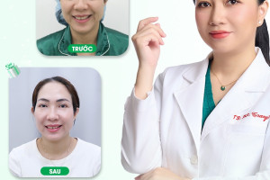 5 kỹ thuật căng da mặt phổ biến hiện nay: Đâu là giải pháp tối ưu?