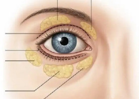 Căng da Midface có giúp làm đầy hốc mắt không?