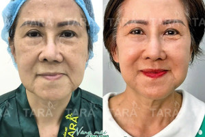 Từ A-Z: Nâng mũi siêu vi phẫu cho người lớn tuổi