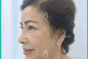 Phẫu thuật căng da mặt: Dấu hiệu bình thường và bất thường