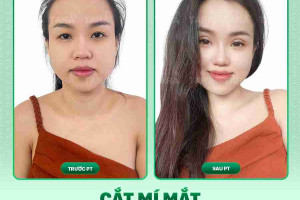 Cắt mí hay nhấn mí? Đâu là lựa chọn tối ưu?