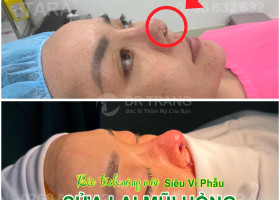 Địa chỉ sửa mũi hỏng siêu vi phẫu bằng trung bì mỡ TPHCM