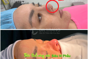 Địa chỉ sửa mũi hỏng siêu vi phẫu bằng trung bì mỡ TPHCM