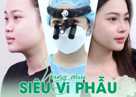 So sánh nâng mũi siêu vi phẫu so với tiêm filler, nâng mũi chỉ