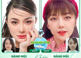 Nâng mũi tự nhiên không bị đơ từ kỹ thuật siêu vi phẫu hiện đại