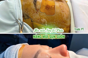 Tại sao cần phẫu thuật nâng mũi siêu vi phẫu chuẩn y khoa