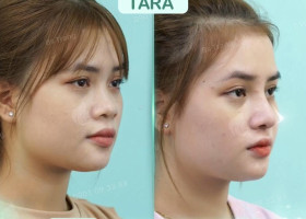 Review bác sĩ nâng mũi siêu vi phẫu Cái Hữu Ngọc Thảo Trang