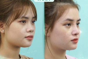 Review bác sĩ nâng mũi siêu vi phẫu Cái Hữu Ngọc Thảo Trang