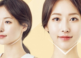 Tiêm tạo hình cằm Vline hay phẫu thuật thì tốt?