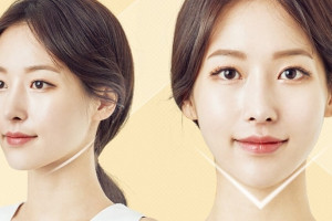 Tiêm tạo hình cằm Vline hay phẫu thuật thì tốt?