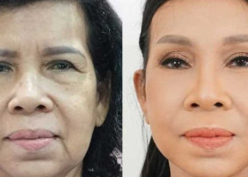 Bác sĩ phẫu thuật căng da mặt nội soi giỏi tại TPHCM
