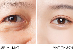 Nên cắt mí hay nâng cung mày để khắc phục mí sụp? Bác sĩ khuyến nghị giải pháp từ siêu vi phẫu