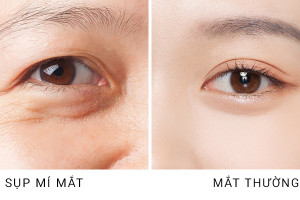 Nên cắt mí hay nâng cung mày để khắc phục mí sụp? Bác sĩ khuyến nghị giải pháp từ siêu vi phẫu