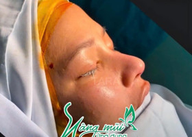 Sửa mũi gãy đẹp hoàn hảo nhờ kỹ thuật siêu vi phẫu hiện đại