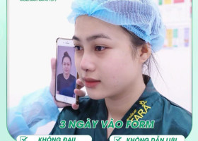 Người bị viêm xoang, huyết áp, tiểu đường có nâng mũi được không?