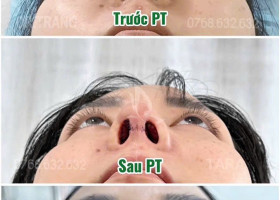 Sửa mũi có đau hơn nâng mũi không và giải pháp “thần kỳ” từ kỹ thuật siêu phẫu