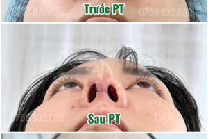 Sửa mũi có đau hơn nâng mũi không và giải pháp “thần kỳ” từ kỹ thuật siêu phẫu