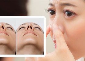 Mũi lệch sau nâng có tự hết không, khi nào cần sửa và giải pháp từ siêu vi phẫu