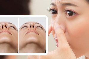 Mũi lệch sau nâng có tự hết không, khi nào cần sửa và giải pháp từ siêu vi phẫu