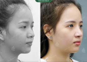 Bác sĩ giải đáp: Nâng mũi có ảnh hưởng đến hô hấp, khứu giác không?