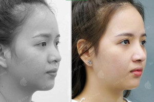 Bác sĩ giải đáp: Nâng mũi có ảnh hưởng đến hô hấp, khứu giác không?