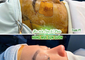 Giải mã ‘nâng mũi không đau’ và cách TS BS Trang TARA kiểm soát đau hiệu quả