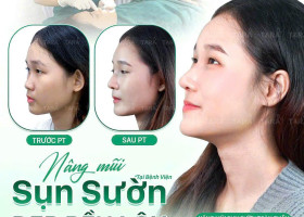 Bác sĩ giải đáp: Sửa mũi bằng sụn sườn có để lại sẹo ở ngực không?