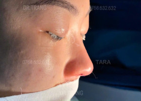Bác sĩ giải đáp: Nâng mũi xong có tháo sụn ra ngay được không?