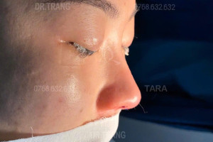 Bác sĩ giải đáp: Nâng mũi xong có tháo sụn ra ngay được không?