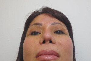 6 dấu hiệu bất thường sau nâng mũi đang gặp vấn đề cần đi khám ngay