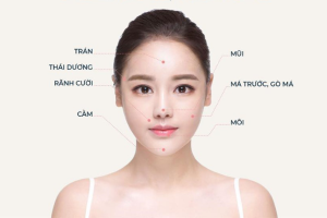 Nên cấy mỡ mặt hay tiêm filler fullface để kịp đẹp trước Tết?