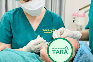 Tiêm fullface trước Tết: nên làm trước bao lâu để tự tin đi chơi?