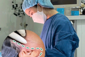 Căng da mặt trước Tết: nên làm trước bao lâu để kịp hồi phục?