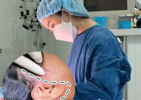 Timeline hồi phục sau phẫu thuật căng da mặt